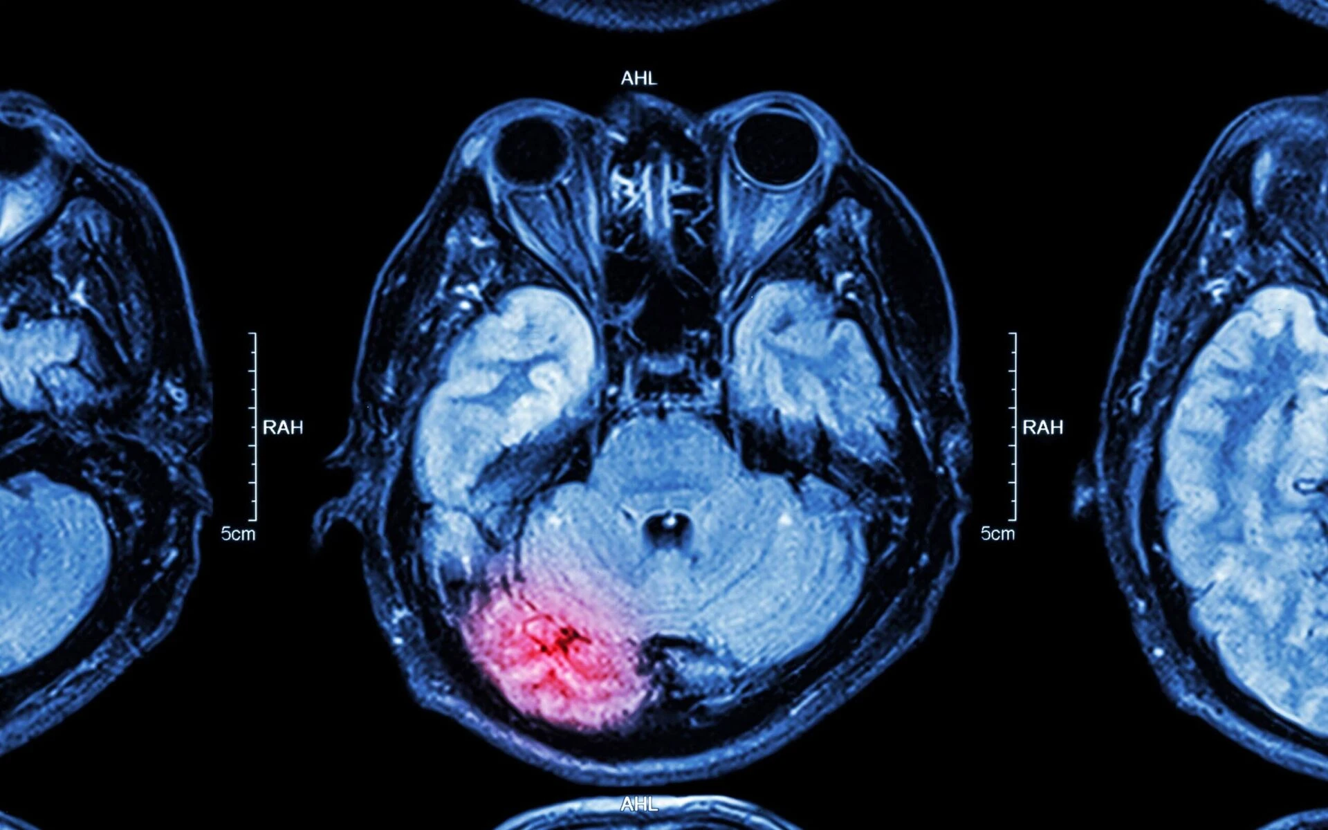 Brain MRI scan for traumatic brain injury diagnosis